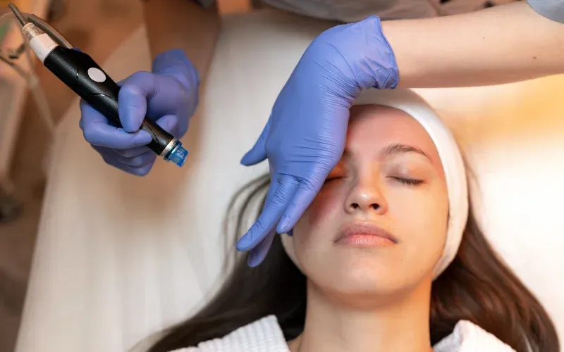 Woman getting a skin microneedling treatment.